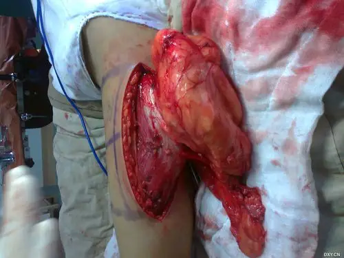 左大腿巨大脂肪瘤