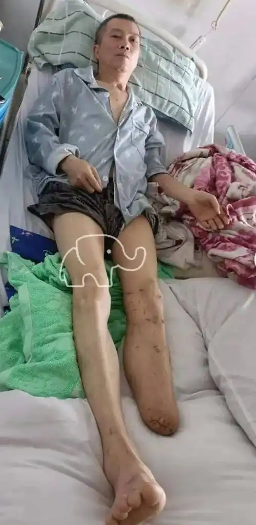 大衙村53岁蔡兄遭遇不幸车祸截肢,落下终生残疾……_后续_龙华街道