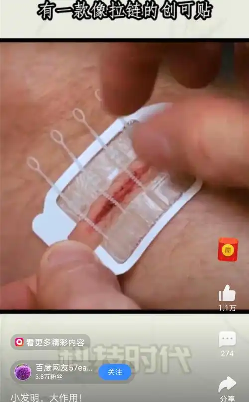 美国研发了一款皮肤拉链(免缝合创可贴),只需要贴在伤口处,通过拉动