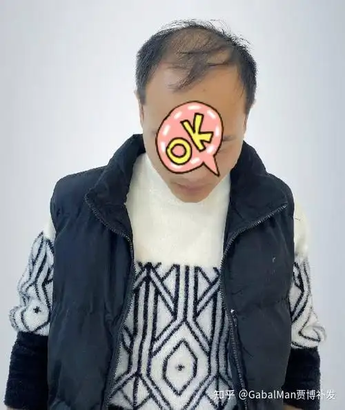 说好一起秃头你却偷偷补了发整整年轻5岁