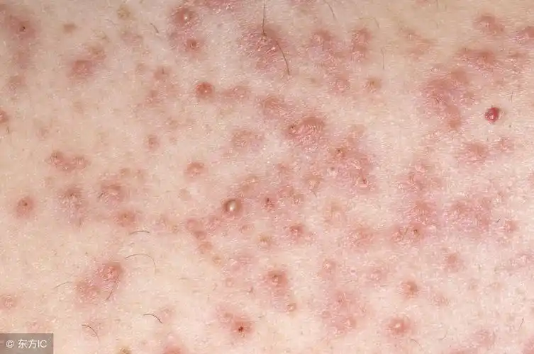 毛囊炎的图片如何辨别毛囊炎有什么预防注意事项