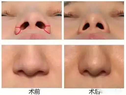深圳鼻孔缩小术_怎么缩小鼻孔_手术对比图