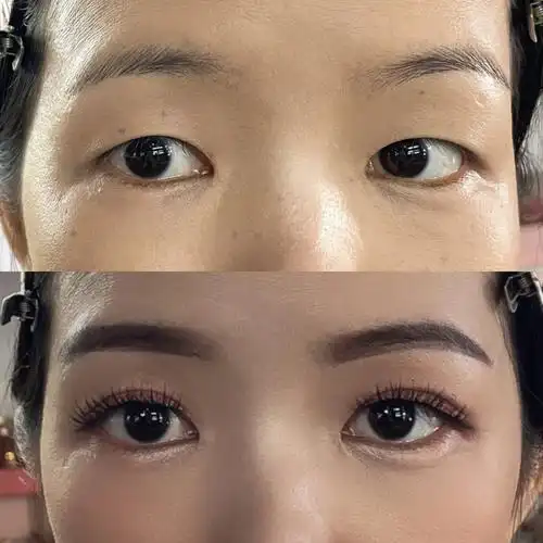 一些单眼皮调整的作品对比图