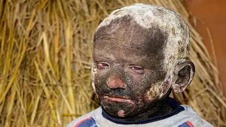 没有心脏?4个世界上最"惨"的人