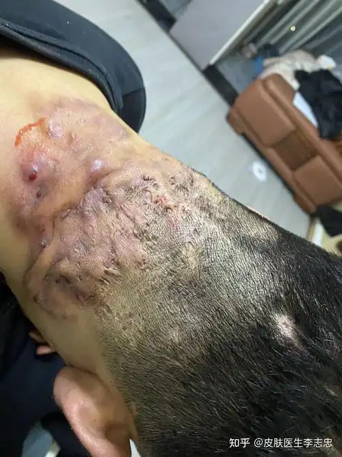 什么是穿掘性毛囊炎中医怎么治