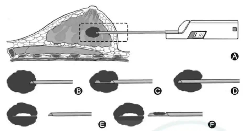 超声引导乳腺病灶和区域淋巴结穿刺活检专家共识与临床操作意见