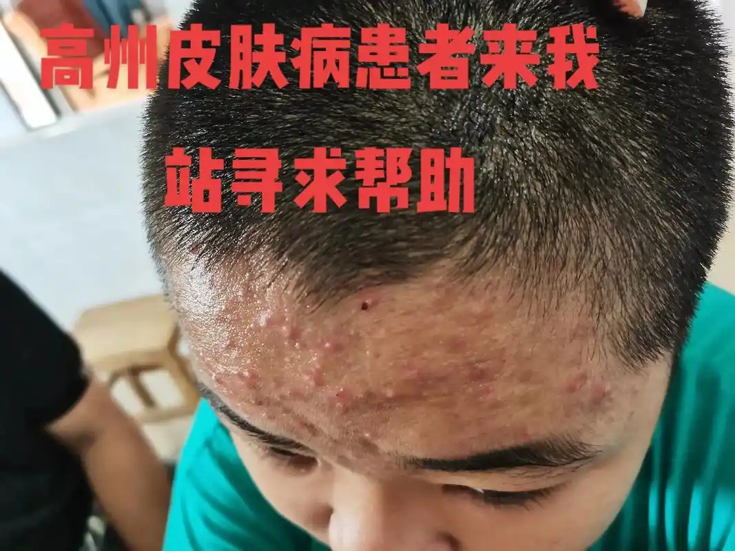 中医传承文化 #中医皮肤科 有缘看到我抖音粉丝的皮肤病来我 - 兑音