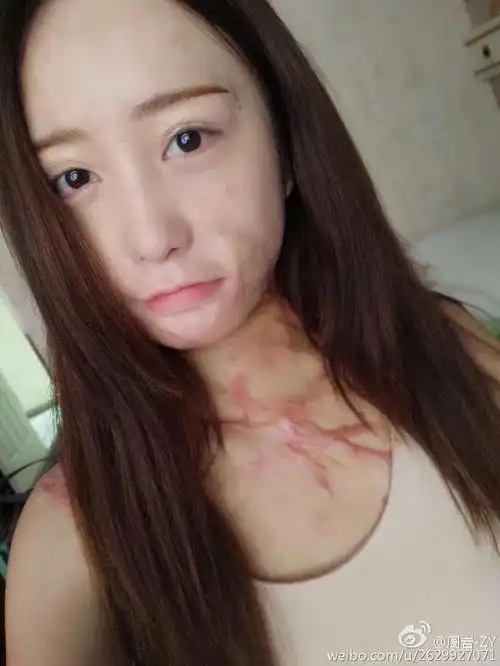 毁容少女周岩乐观生活,旅游赚钱一样不落下