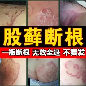 止痒药膏私处男女