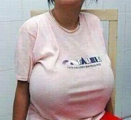 10岁女孩长出八斤乳房竟是吃多了某种食物女孩子要注意