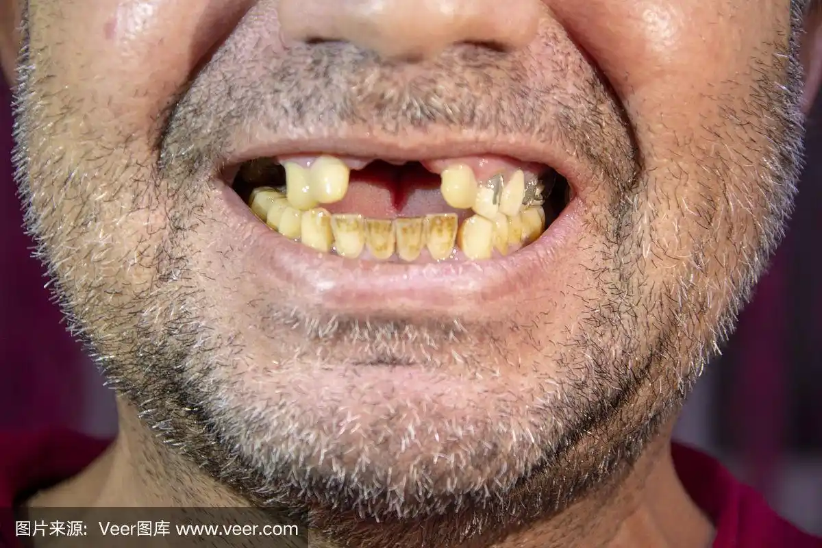 没牙的男人,黄牙的微笑男人