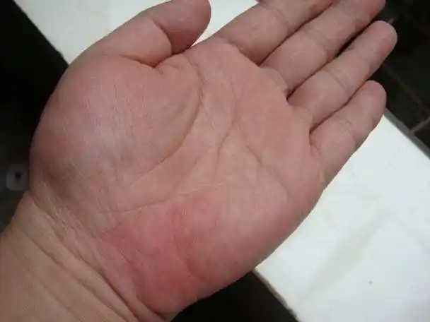 肝癌前期不痛不痒,医生:一旦出现"3红1臭",警惕肝脏"癌变"