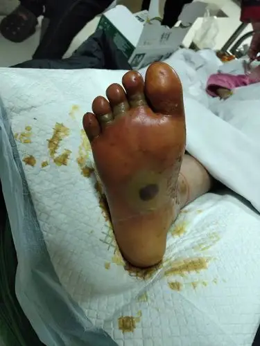 一个小女孩,脚部严重受伤,揪动着点滴公益,萤火虫和社会各界爱心人士