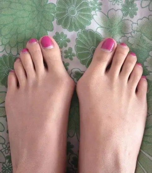 高跟鞋脚腕变形