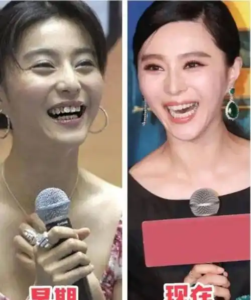 刘涛牙齿脱落,吴宣仪嘴巴合不上,明星们的大白牙真的好看吗?