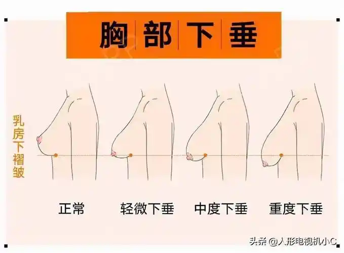 乳房怎么下垂胸下垂松弛