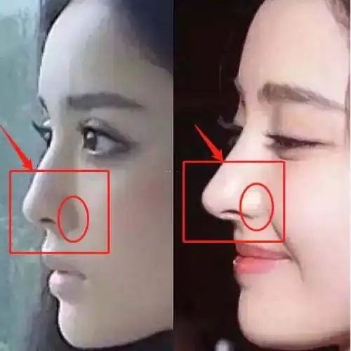 即使是明星也有不少通过整形来调整,但鼻翼缩小过度导致鼻孔过小也会