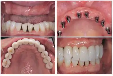 种植牙价格_牙齿矫正|福州种植牙中心|福州隐形矫正中心|福州牙科医院