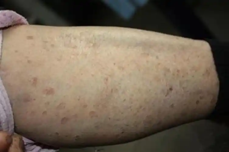 孕妇疥疮初期腹部皮肤症状图片