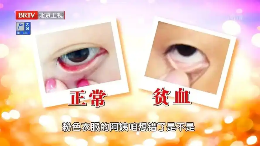 3,突然白发,脱发2,倦怠乏力1,眼睑发白,指甲发白,口唇白有贫血的症状2