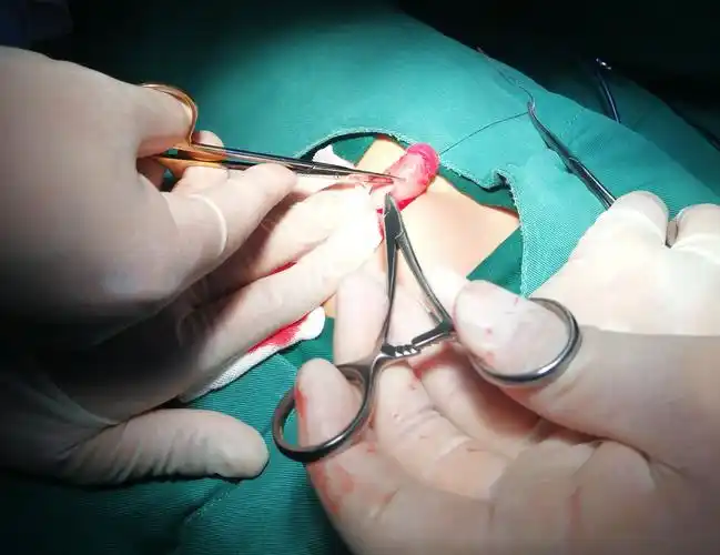 经包皮入路联合阴茎阴囊角重建隐匿阴茎矫形术