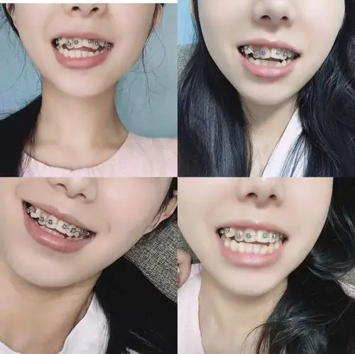 正畸一个月的变化 虎牙排齐了一个_正畸_美妆_医美整形