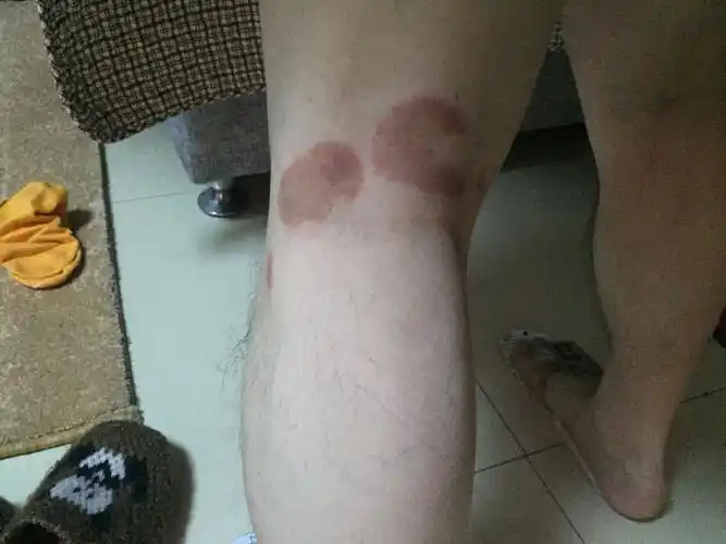 爸爸膝盖后面的腿窝子那里长了一大块癣一样的东西,不痛,偶尔会痒