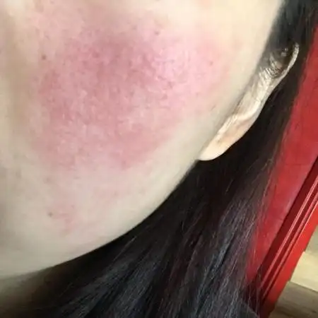 跪求怎么治,本身就是敏感皮肤,去年冬天也过敏了脸蛋发红,刺痒,擦化妆