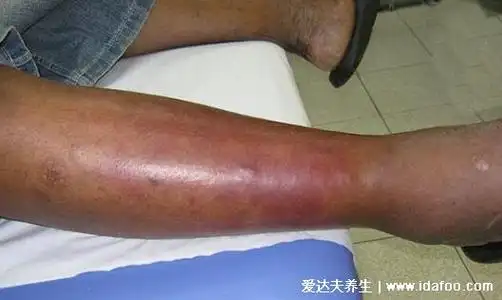 是皮肤上层的一种细菌感染,多发于面部,腿部,发病很急,会导致皮肤上