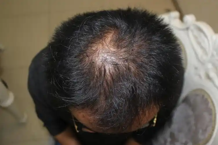 男人掉头发很厉害怎么办:食物调理