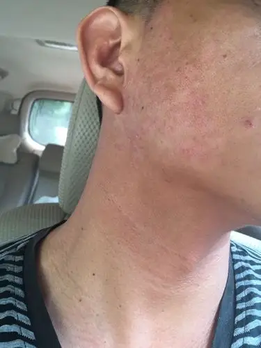 脸上起皮还红红的是什么情况 谢谢