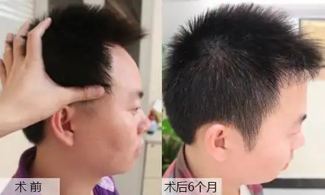 杭州鬓角种植需要多少钱