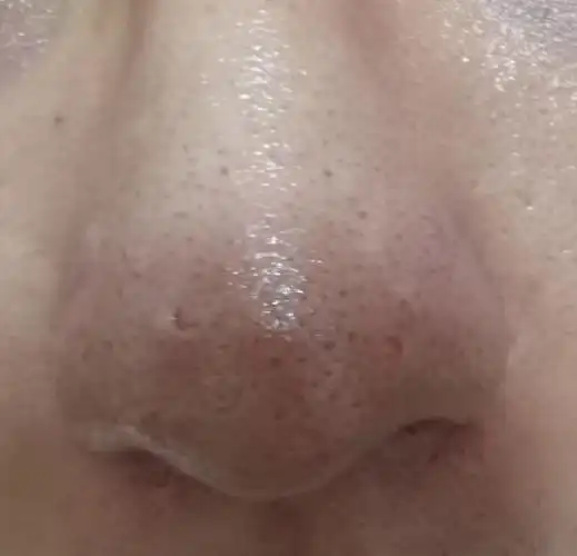 鼻部的毛孔粗大和痘坑如何治疗?-吴余乐副主任医师-爱问医生