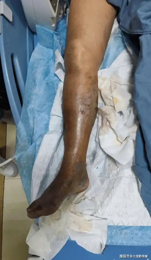 宁波阿姨海边玩一下午,第4天竟被截肢!