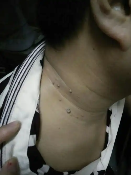 我老公脖子上长了好多小肉肉是什么啊