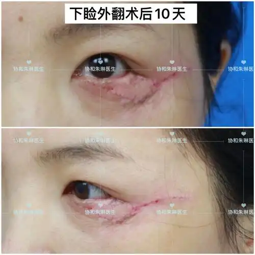 眼睑外翻_发病原因_治疗方式 - 好大夫在线