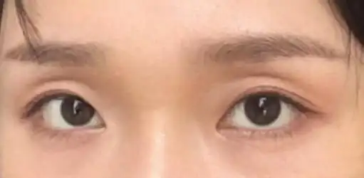 ①上眼睑凹陷形成的三角眼 (如图)