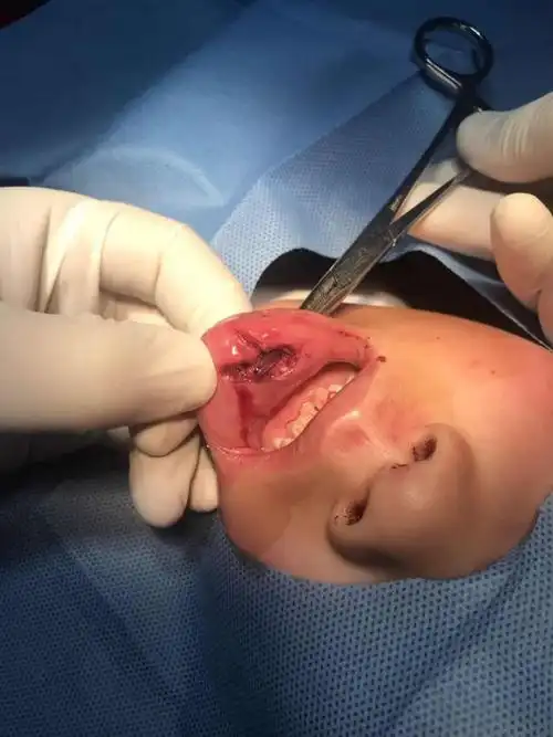 贯通伤皮内缝合结合医用胶粘合病例分享