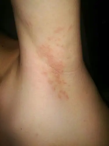 腋下,一片红,很痛,好像有脓(不确定),怎么回事?该怎么办?