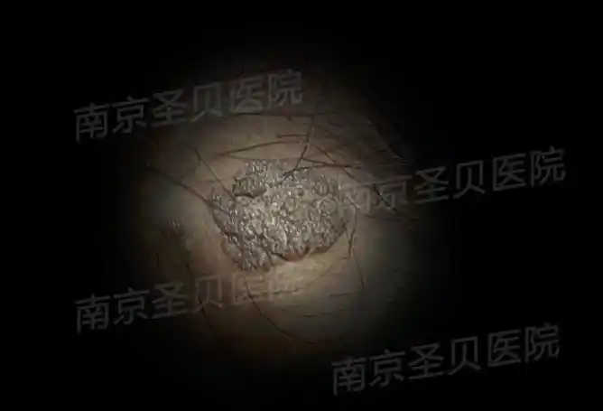 病毒(hpv),该病毒是一种球形dna病毒,主要侵犯人体的外阴生殖器或肛周