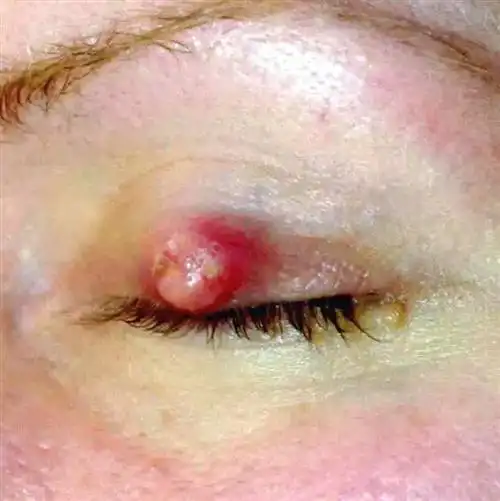 左眼睑板腺囊肿怎么办?