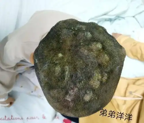 头皮发麻!姐弟俩先后因脓癣入院,问题竟出在家里来的"新成员"