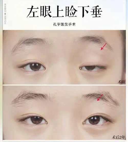 重症肌无力上睑下垂如何治疗?检查,诊断,制定方案,术后护理