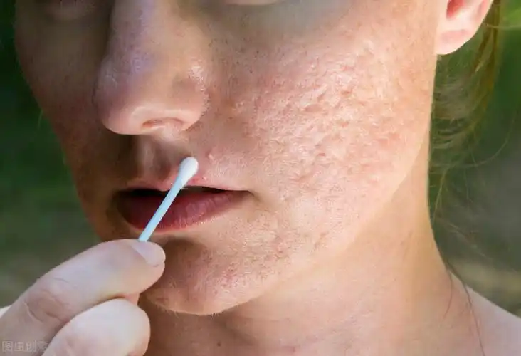 刷酸是什么,在护肤中有什么作用?