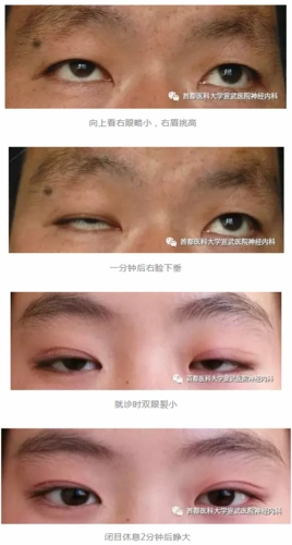 眼睛睁不开是得了重症肌无力吗