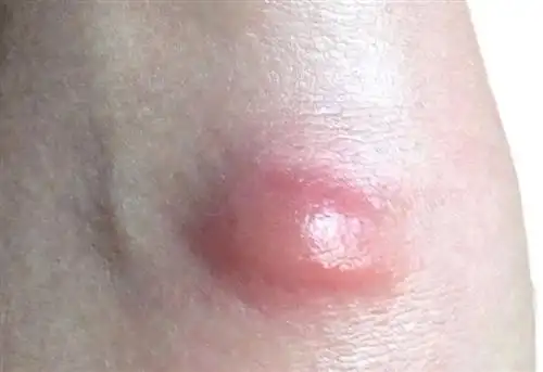 外阴疖肿有什么症状