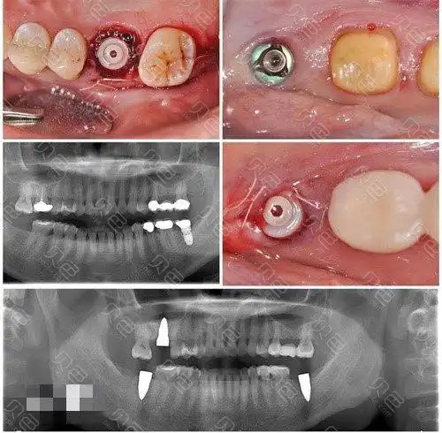 上海种植牙医院排名前十排行榜名单,均为正规上海种牙医院!