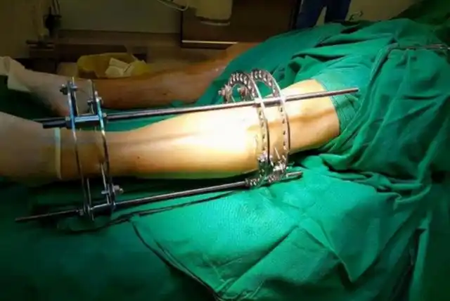 2014年,小伙为长高7.2厘米花16万,敲10根钢钉进腿骨,有必要吗