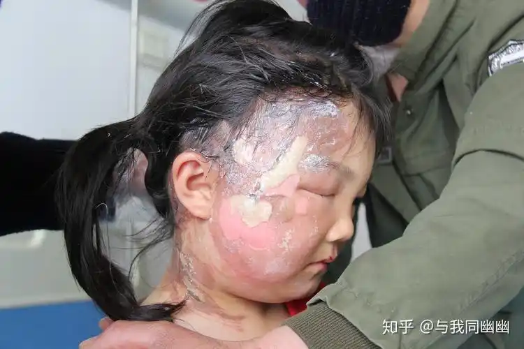 活动时间:6月1号—6月30号支持单位:长沙长峰医院烧伤治疗中心(儿童烧