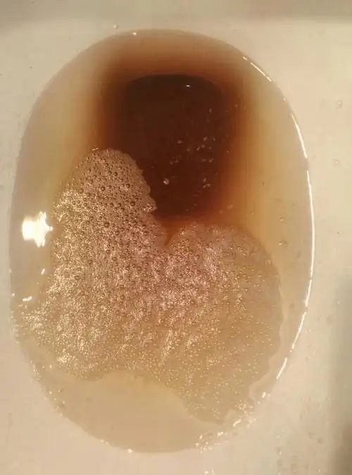 尿褐色沉淀是怎么回事